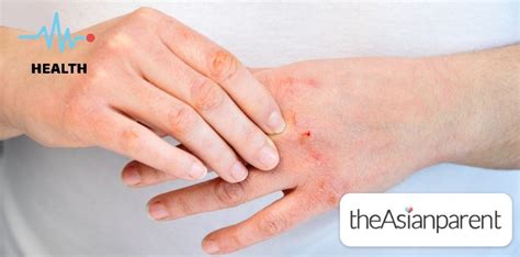 Sugat Sa Kamay: Sanhi, Sintomas, Gamot At Home .
